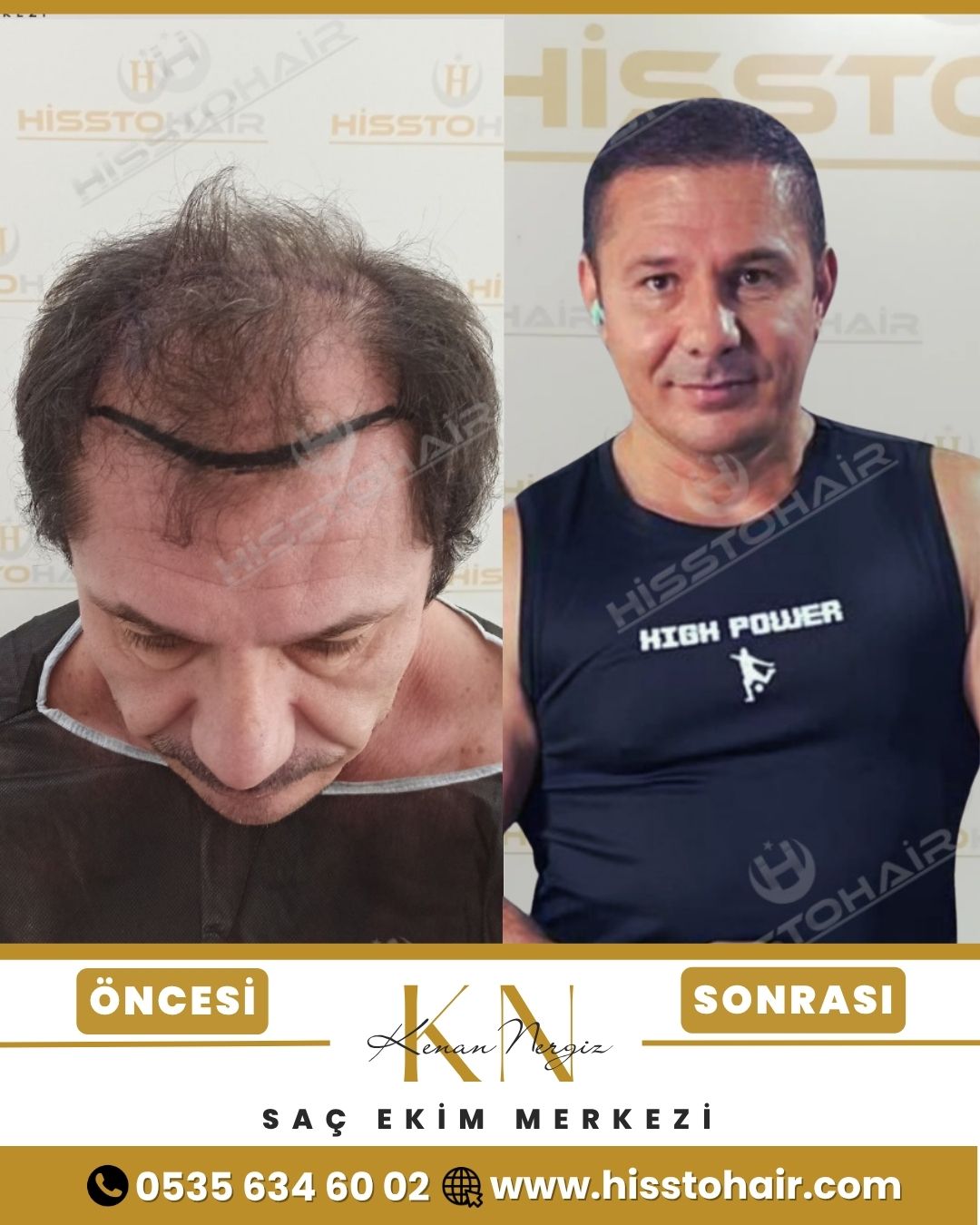 İzmir Dikili Saç Ekim Sonuçları