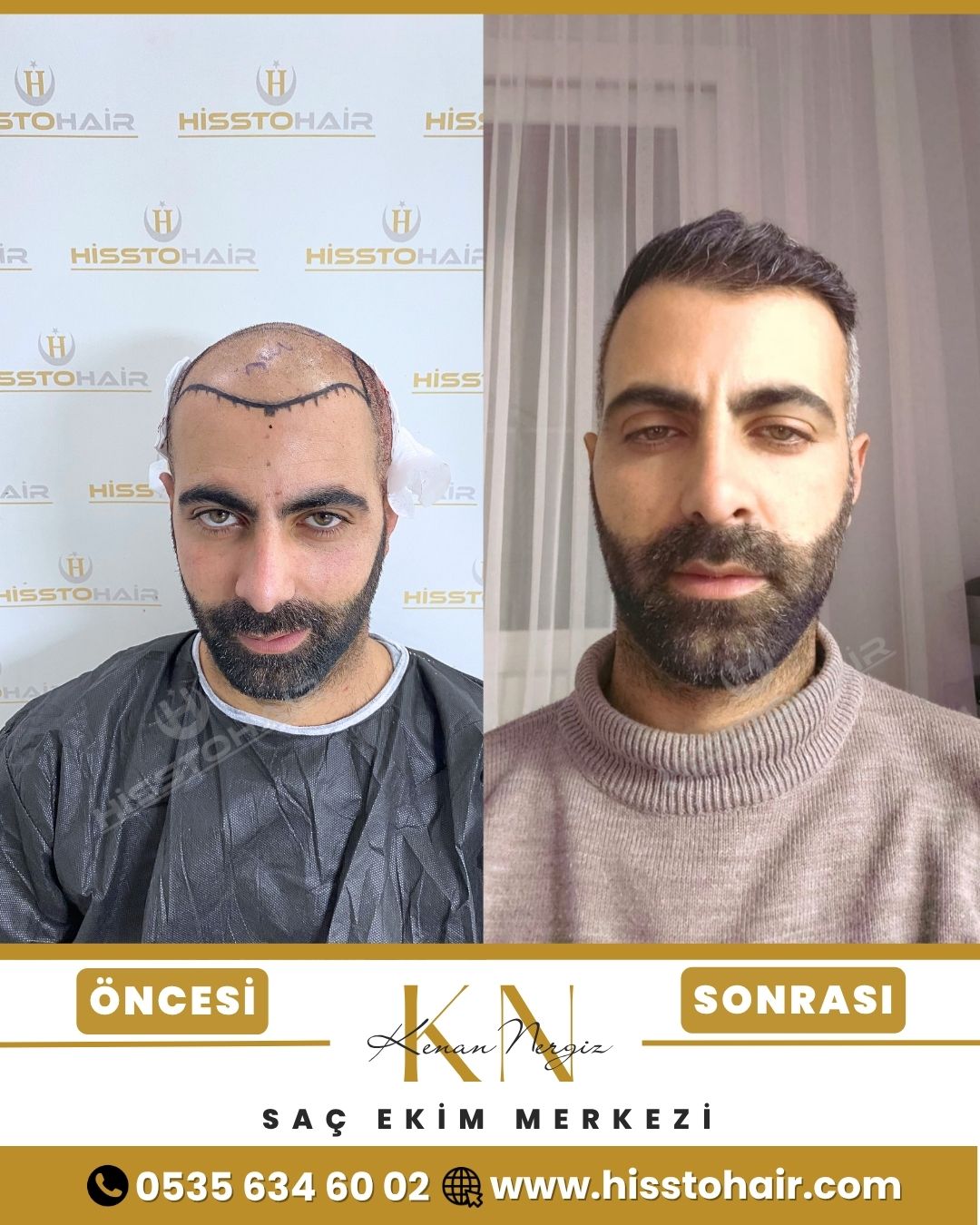 İzmir Dikili Saç Ekim Sonuçları