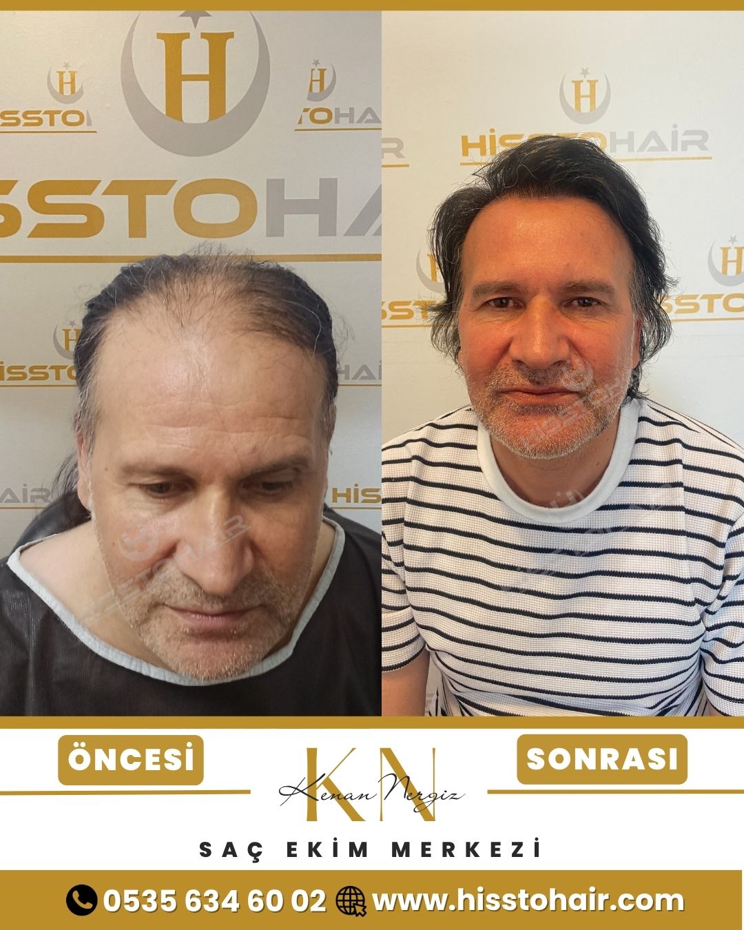 İzmir Dikili Saç Ekim Sonuçları